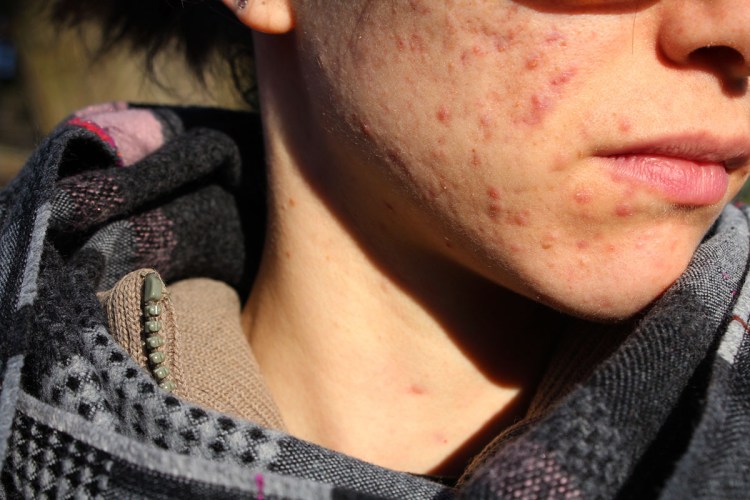 animal,sensible,blog,rougeurs,instagram,acné,boutons,points,noirs,dermato,maladie,peau