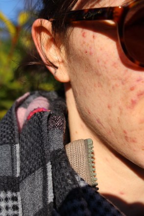 animal,sensible,blog,rougeurs,profil,instagram,acné,boutons,points,noirs,dermato,maladie,peau